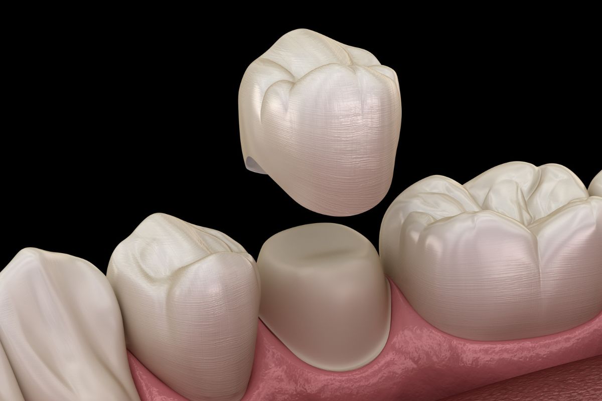 dental crown placement