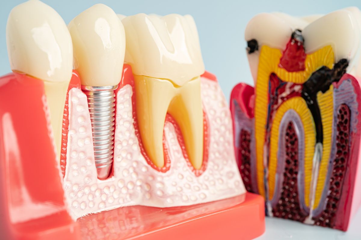 Missing Teeth Ruining Your Confidence How Dental Implants Can Change Everything