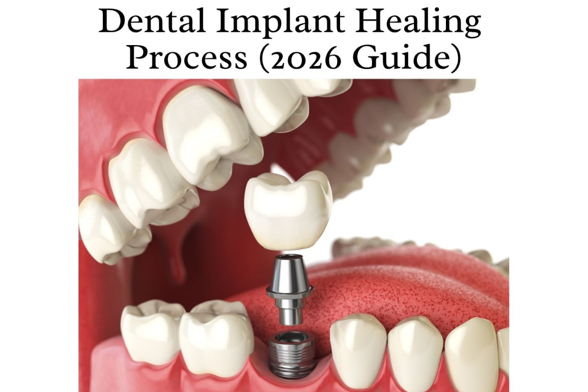 Dental Implant Healing Process Timeline, Foods & What to Expect (2026 Guide)