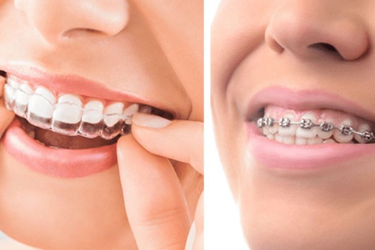 invisalign vs braces adults