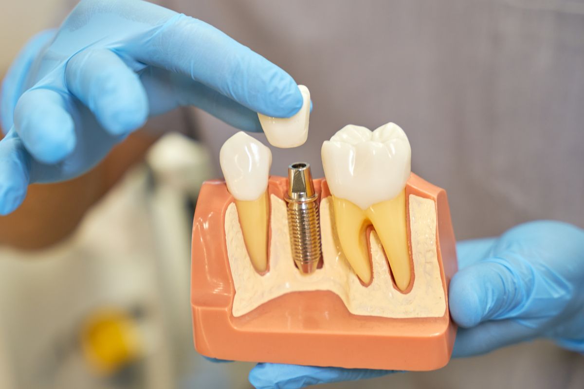 Signs you need dental implants
