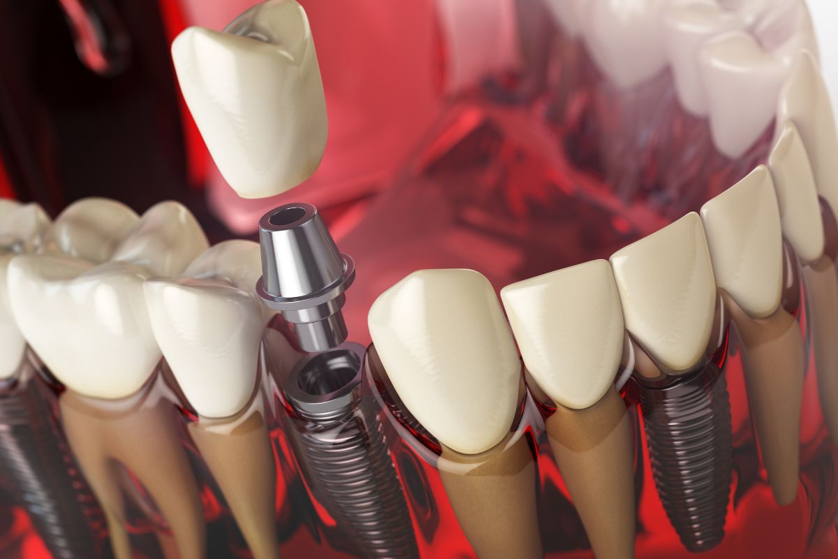 Can Bacteria Affect Dental Implant Healing